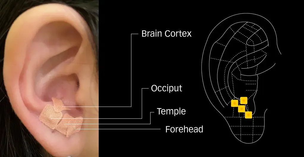 Ear seed plasters on Brain Cortex, Occiput, Temple, and Forehead points