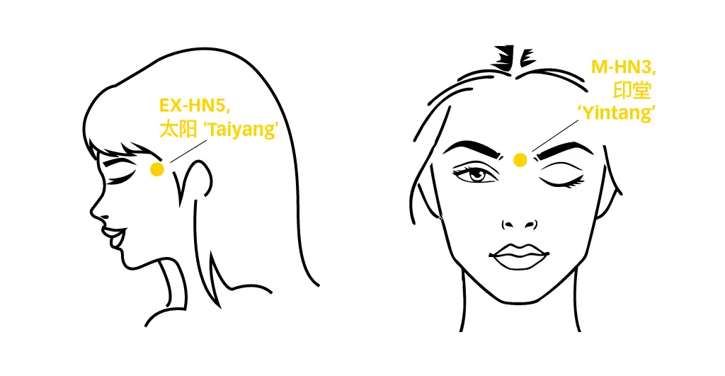 Profile and front diagrams labelling Taiyang at the temple and Yintang between the brows for migraine ice glide