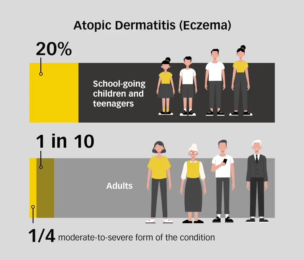 Atopic dermatitis eczema prevalence in children, teenagers, and adults