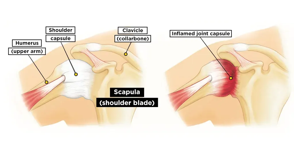 Diagram comparing a healthy shoulder capsule with an inflamed frozen shoulder capsule