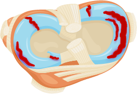 Top-down diagram of torn menisci in the knee