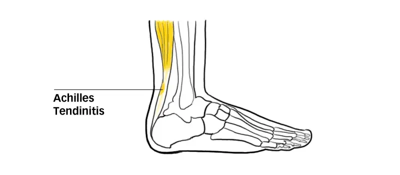 Diagram of Achilles tendinitis at the back of the heel