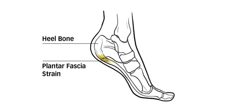 Diagram of the plantar fascia under the heel for heel pain