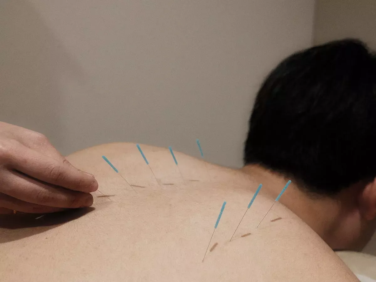 Acupuncture needles along the upper back for soft-tissue pain care