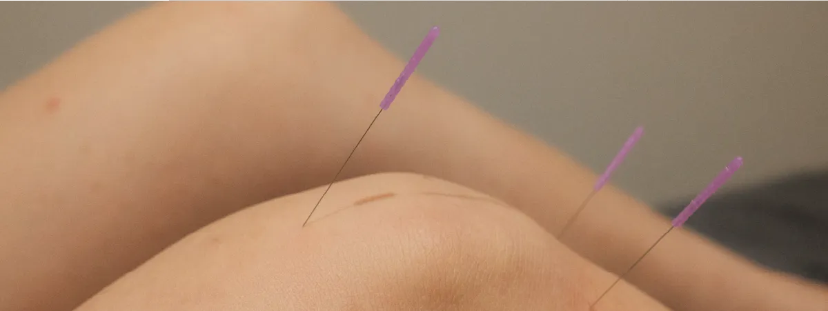 Acupuncture needles at the side of a bent knee