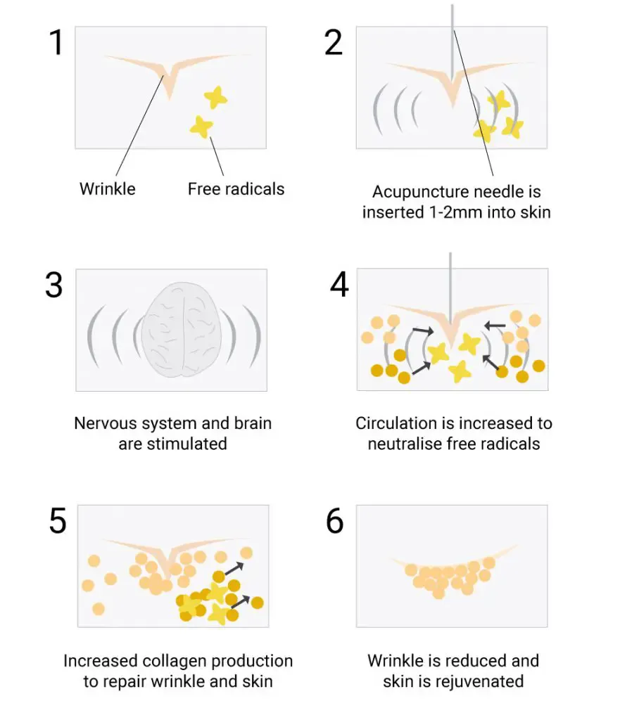 Six-step teaching diagram of facial acupuncture: needle insertion, circulation, collagen, and wrinkle softening