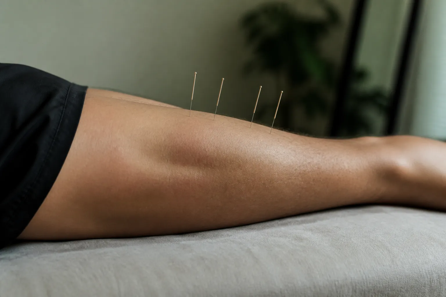Acupuncture needles in an athlete’s calf for DOMS recovery in clinic