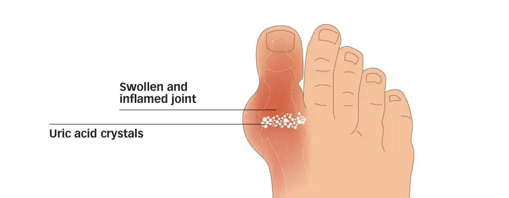 Diagram of a swollen big-toe joint with uric acid crystals in gout