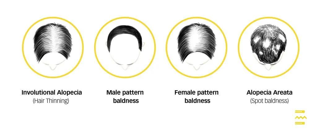Diagram of four hair loss types: thinning, male pattern, female pattern, alopecia areata
