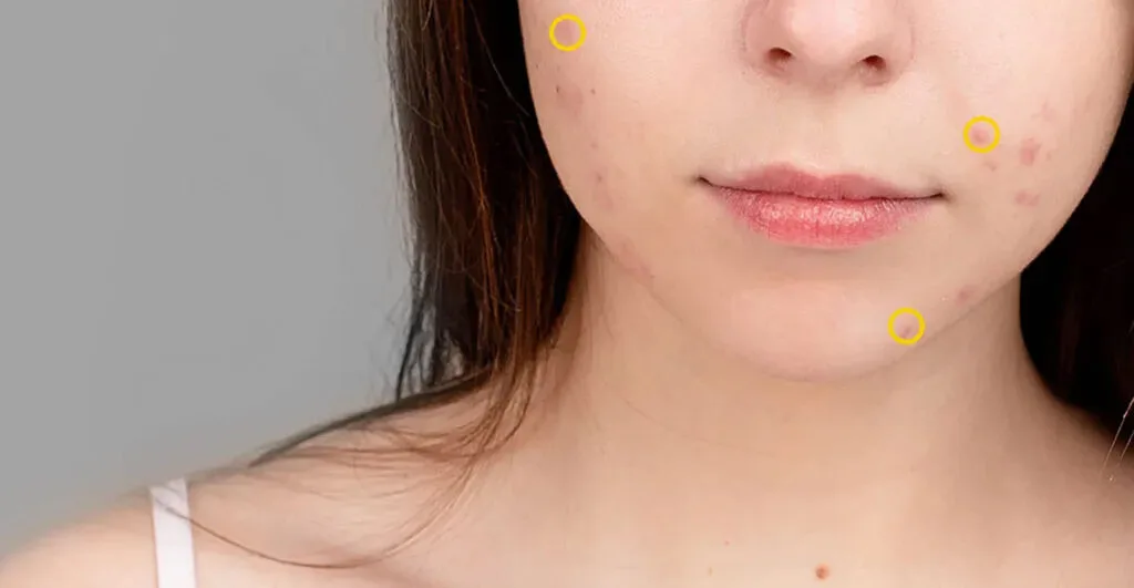 Facial acne on the cheeks and chin at PULSE TCM