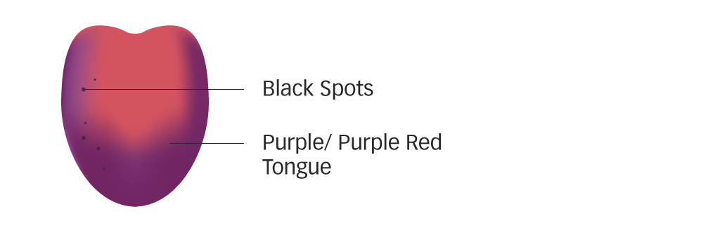 Diagram of a purple-red tongue with black spots for blood stasis
