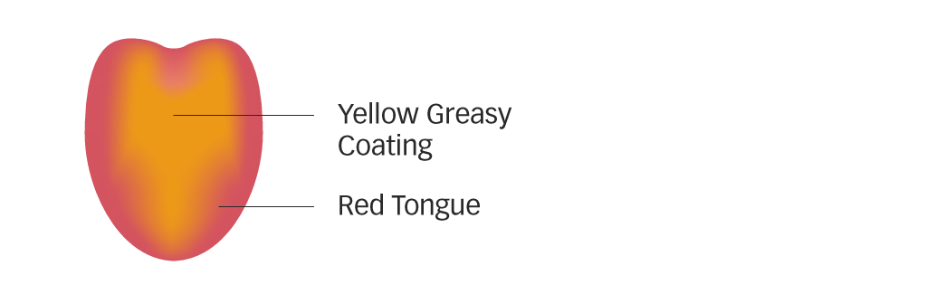 Diagram of a red tongue with yellow greasy coating for damp heat
