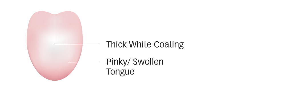 Diagram of a swollen tongue with thick white coating for phlegm-damp
