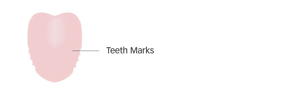 Diagram of a pale tongue with teeth marks for Qi deficiency