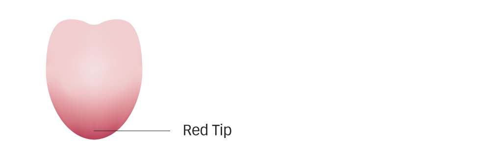 Diagram of a tongue with a red tip for Qi stagnation