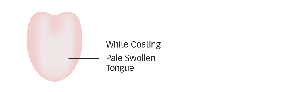 Diagram of a pale swollen tongue with white coating for Yang deficiency