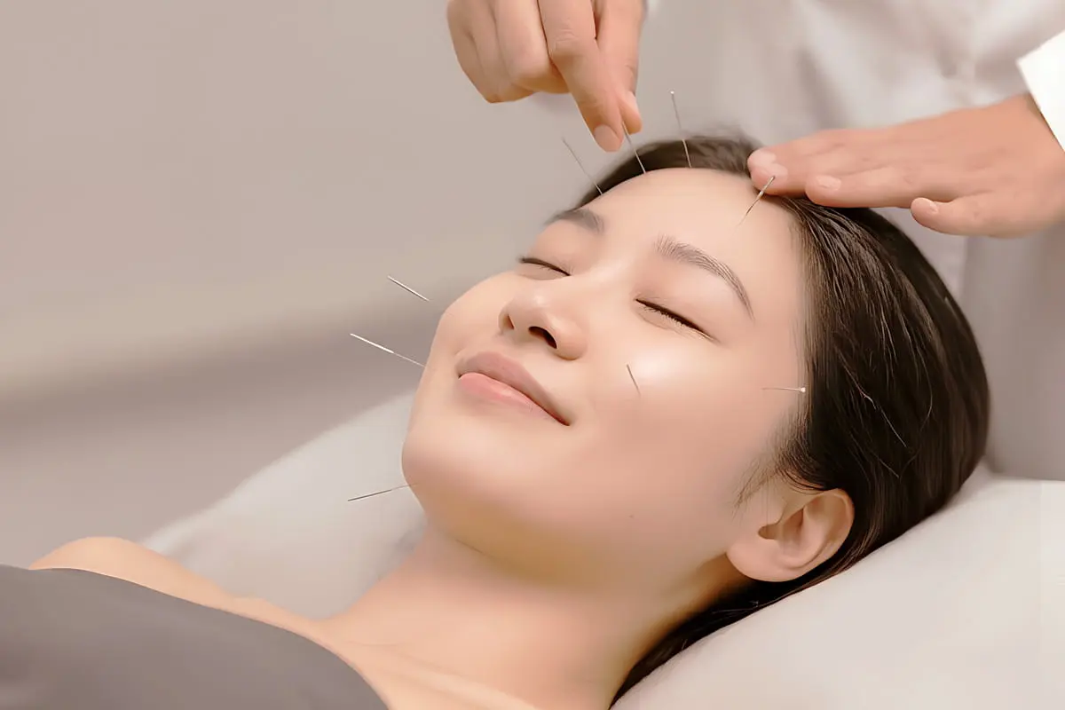 Facial acupuncture for acne care at PULSE TCM
