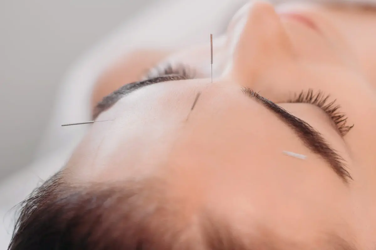 Periocular acupuncture for eye care at PULSE TCM