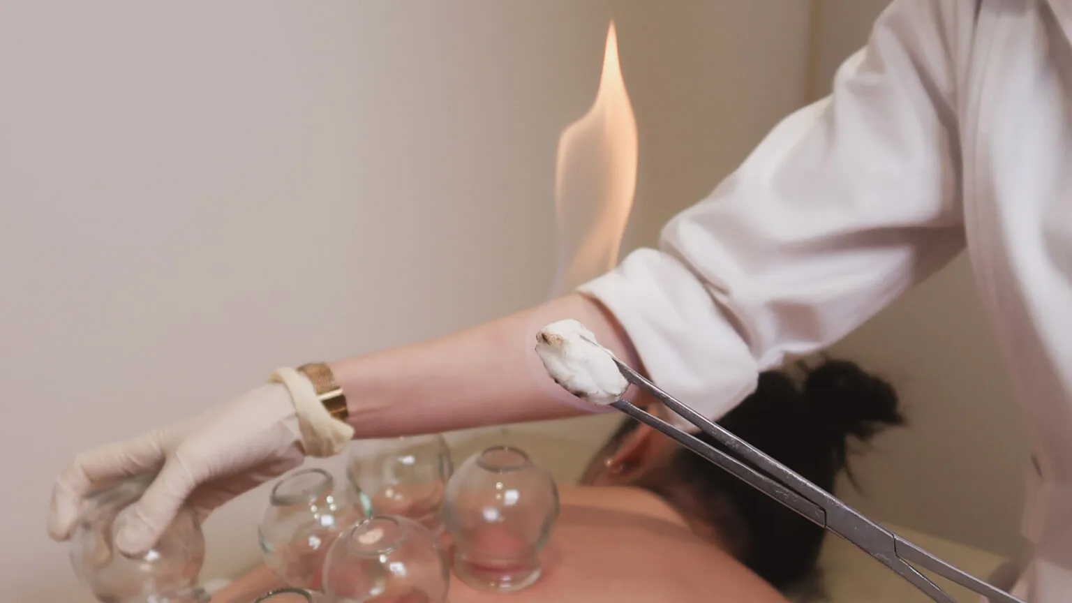 Therapeutic cupping used when indicated in skin care