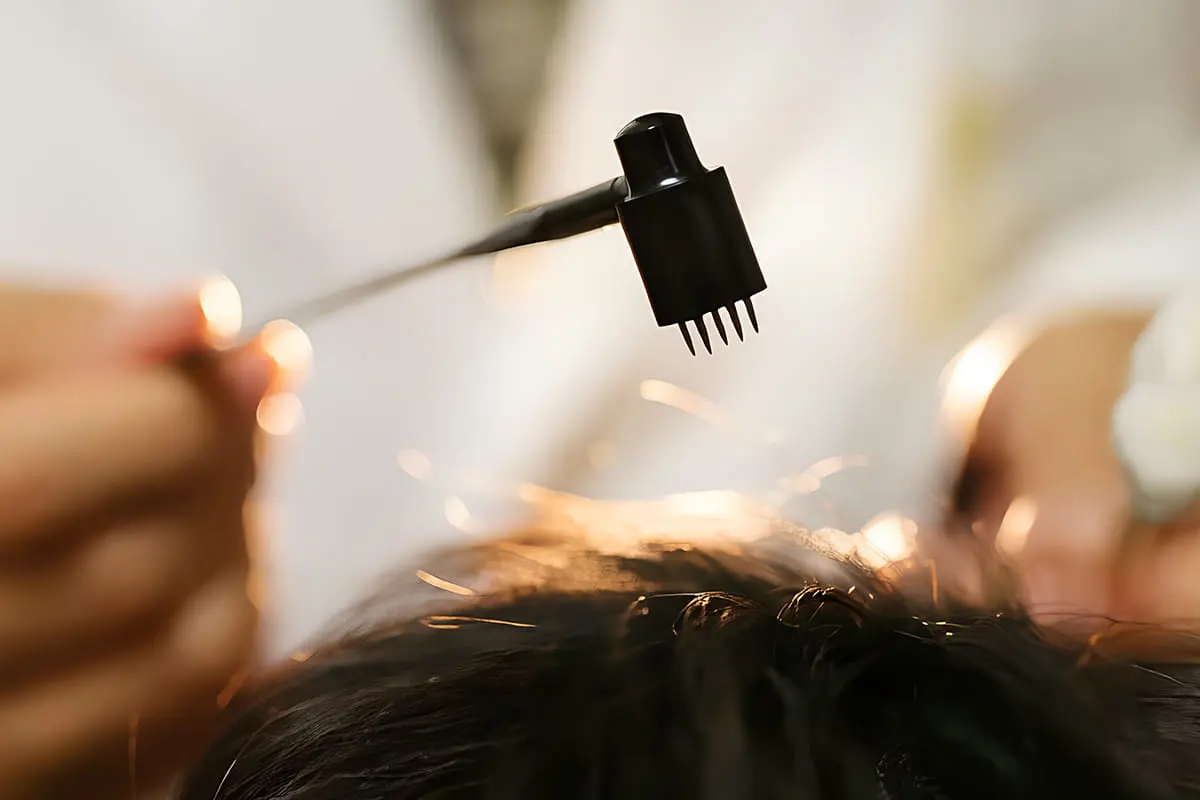 Plum blossom needling on the scalp at PULSE TCM
