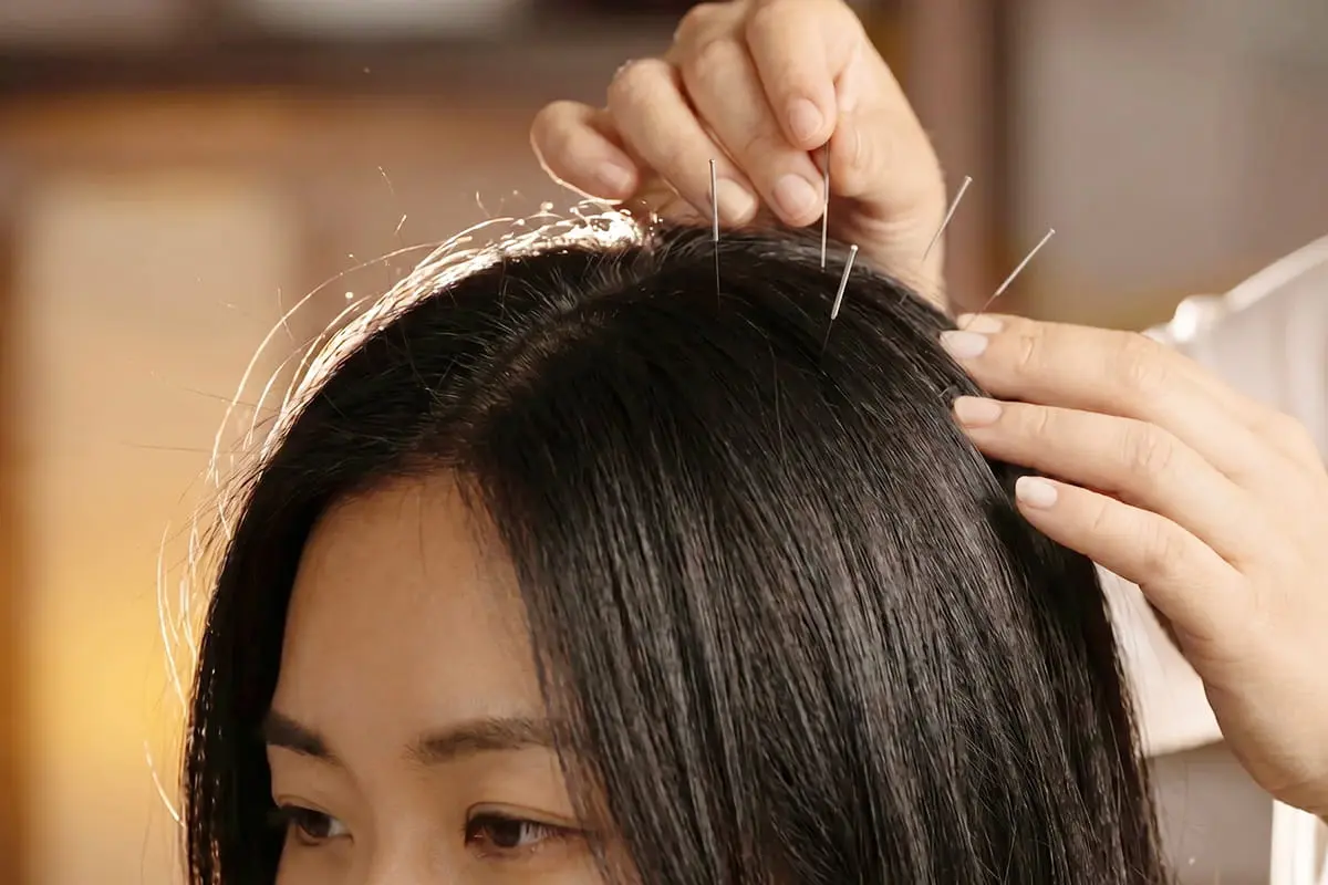 Scalp acupuncture for hair-loss care at PULSE TCM