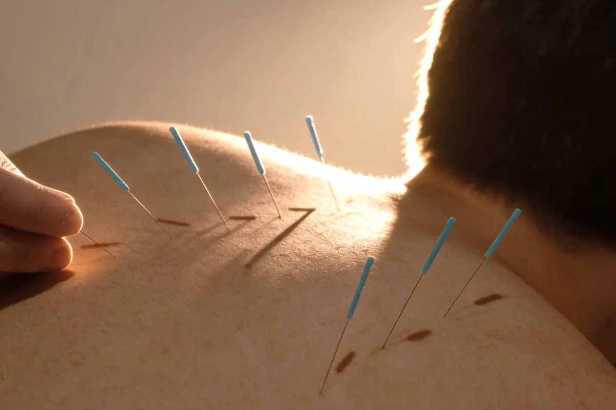 Clinical acupuncture for insomnia at PULSE TCM
