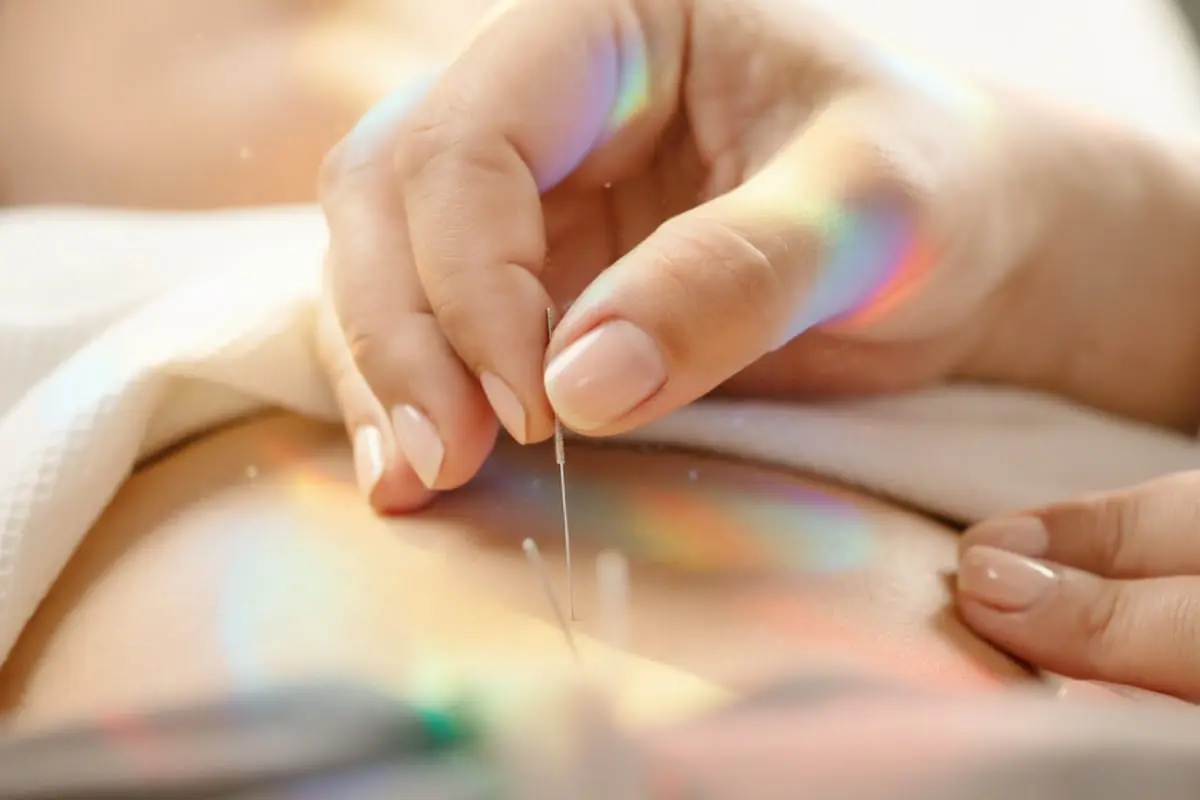 Acupuncture supporting digestion and circulation at PULSE TCM