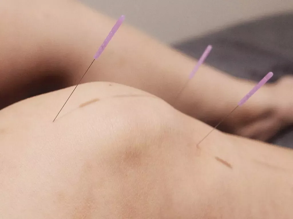 Acupuncture needles on the knee during TCM treatment at PULSE