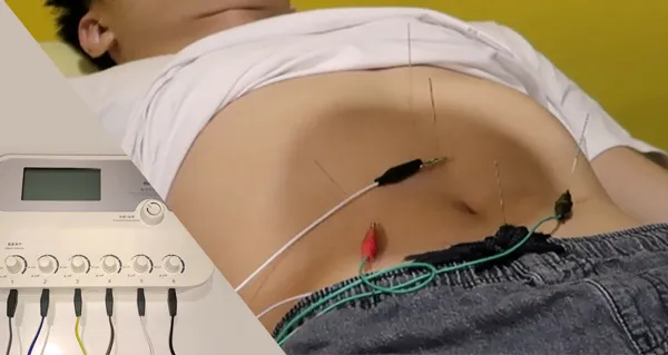 Electroacupuncture illustration