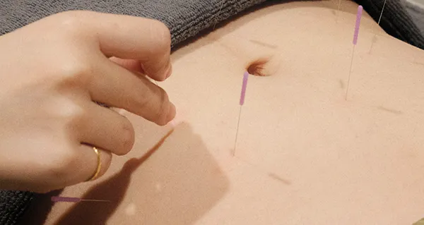 Traditional acupuncture illustration